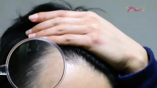 معي اليك أكثر مشكلات الشعر الشائعة وأفضل الحلول الممكنة